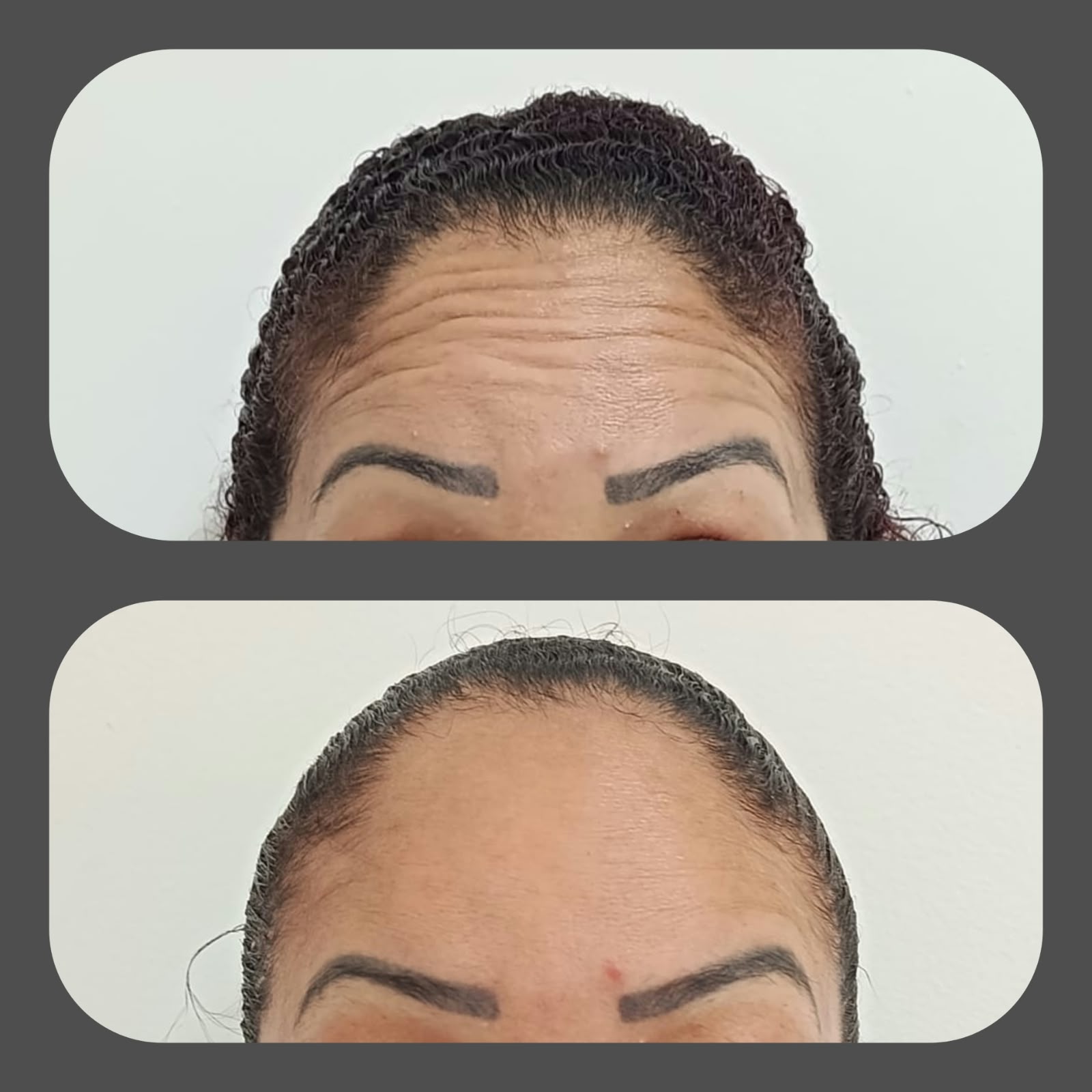 Antes e depois de procedimento de estética facial